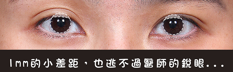 無痕提眼瞼肌 X BEAUTY LOCK深眸術 X 肉毒瘦小臉