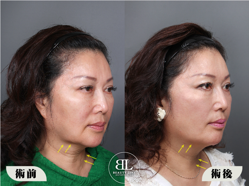 凍齡媽媽的美麗秘密!埋線拉提心得分享