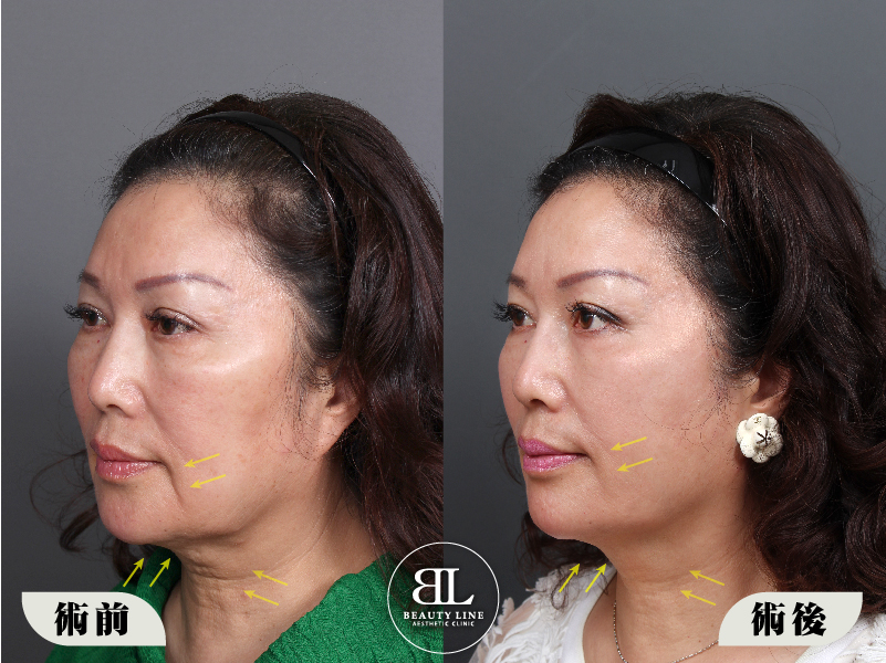 凍齡媽媽的美麗秘密!埋線拉提心得分享