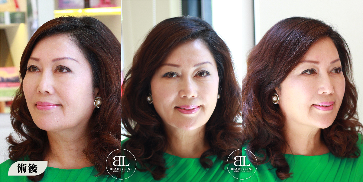 凍齡媽媽的美麗秘密!埋線拉提心得分享