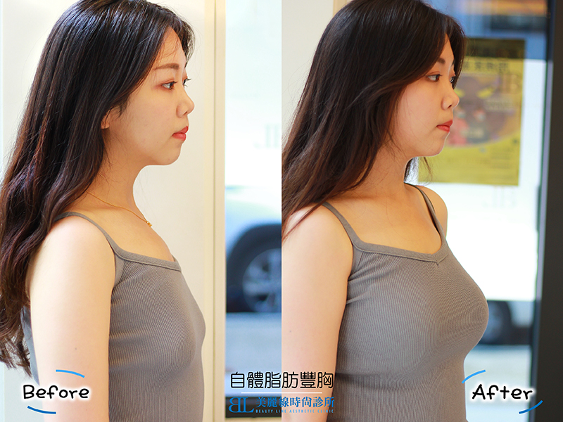 自體脂肪豐胸