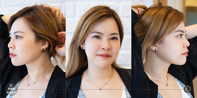 雙下巴困擾多年,五六的埋線拉提心得分享