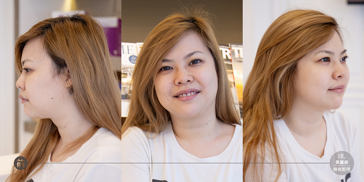 雙下巴困擾多年,五六的埋線拉提心得分享