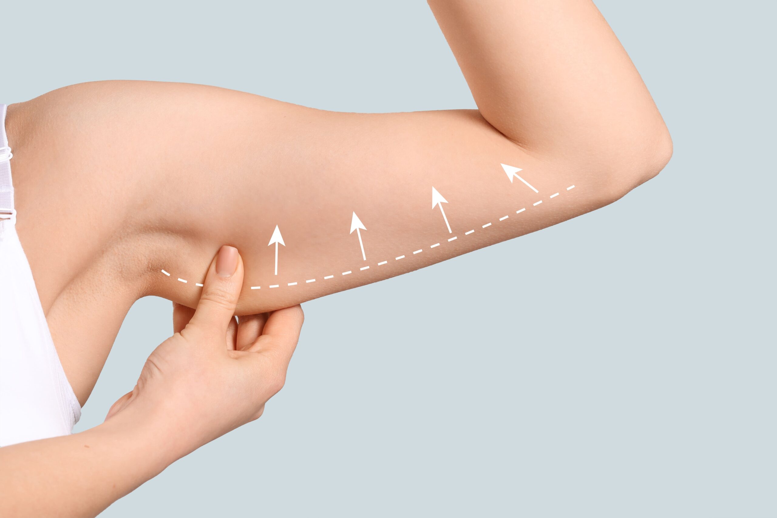Q1. 手臂抽脂 後會有不適感嗎？過程中可能會有輕微不適，但通常可以透過醫師開的藥物緩解。Q2. 恢復期需要多久？ 恢復期因人而異，一般需要數週至數月。Q3. 是否會有疤痕？抽脂過程中使用微小切口，疤痕通常相當隱痕