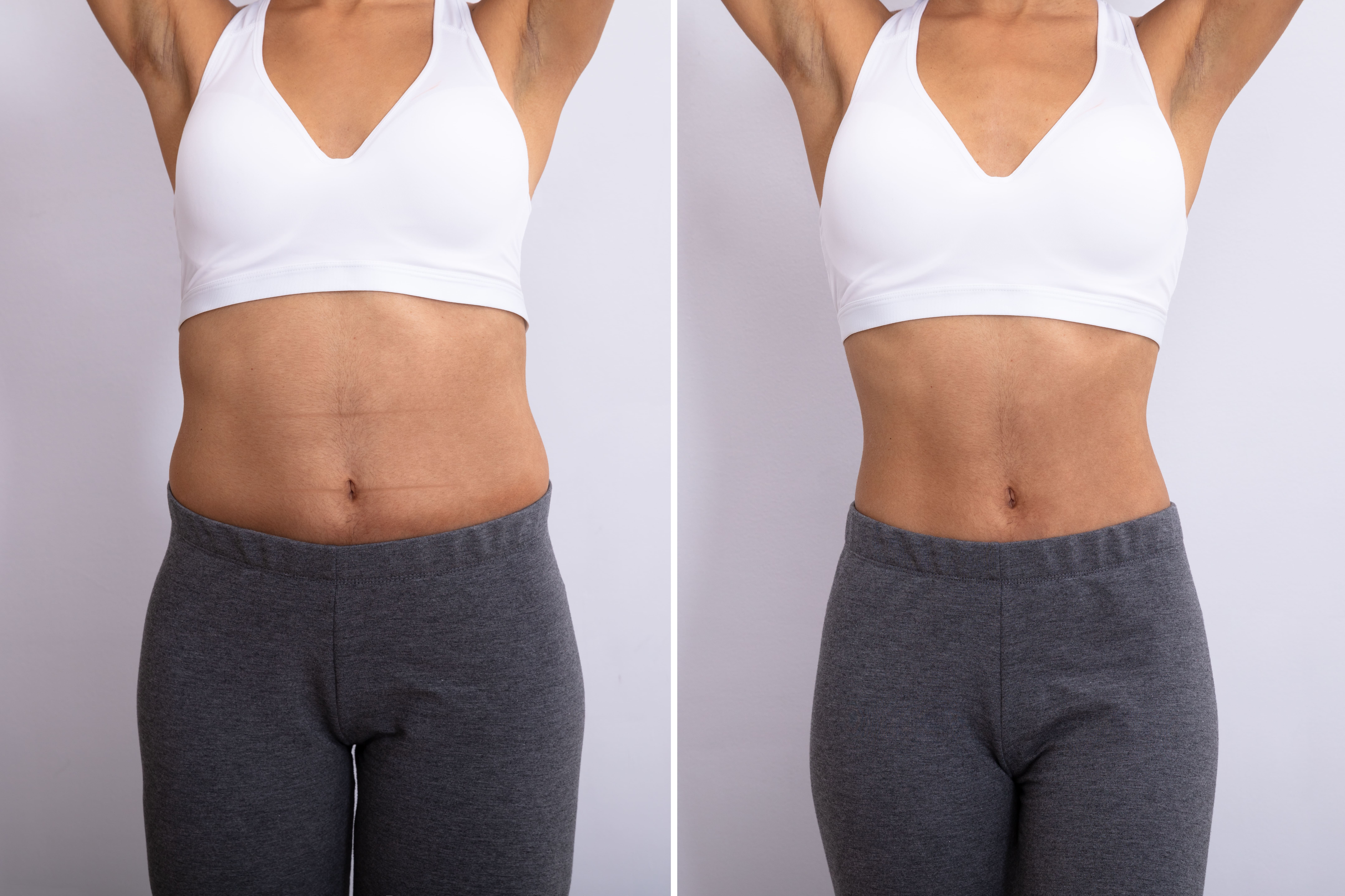 下圖為腹部環抽效果，左邊為抽脂前，右邊為抽脂後，明顯看出腰身，讓身型比例在視覺上更為修長。