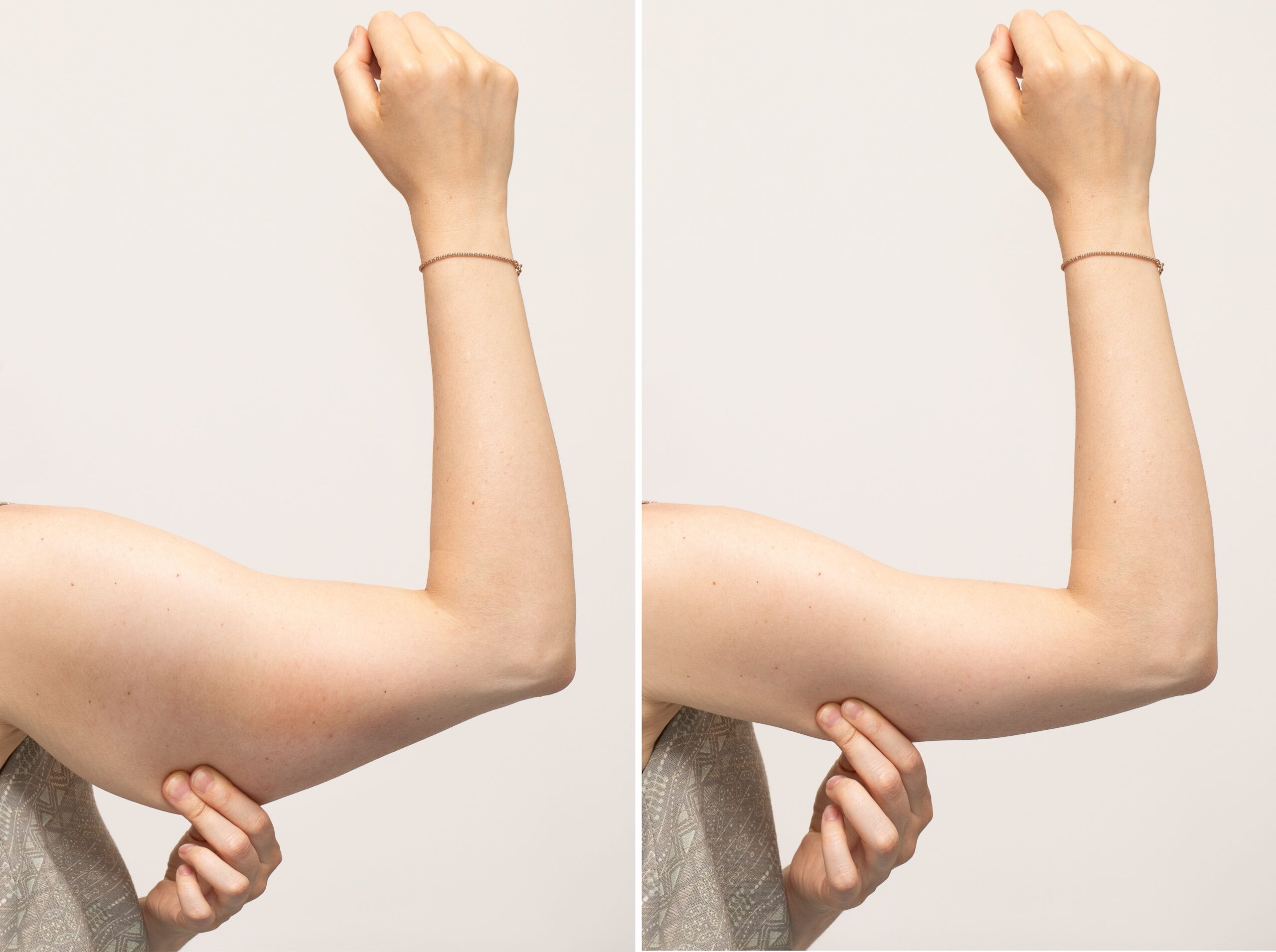 下圖為手臂抽脂前後對比，可在右圖看到手臂抽脂後，蝴蝶袖的部份明顯減少，手臂纖細不少。