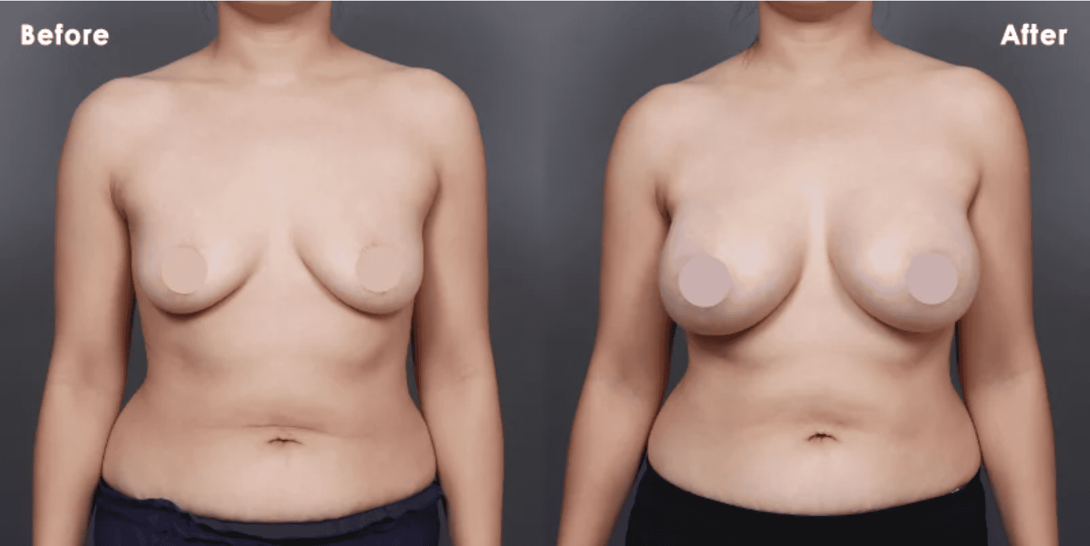 內視鏡魔滴隆乳手術前後女性並排比較，清楚顯示乳房大小和形狀的變化。-A