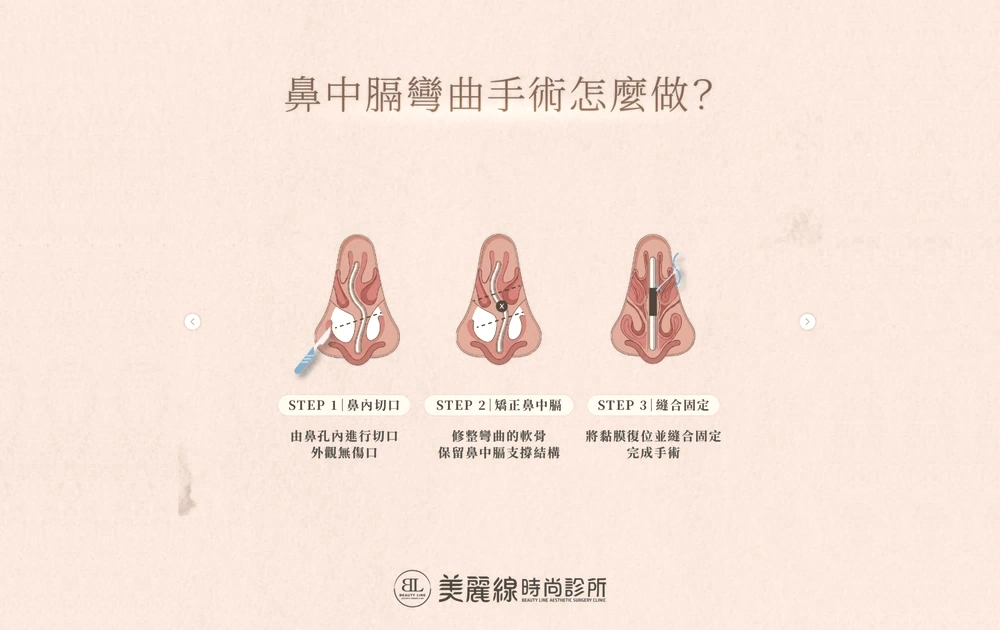 鼻中膈彎曲矯正手術的鼻內切口、矯正鼻中膈及縫合固定三步驟示意圖