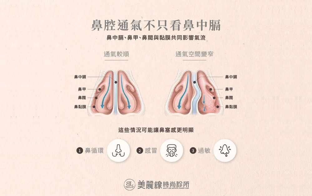 鼻中膈彎曲造成鼻道變窄及影響鼻腔通氣的示意圖