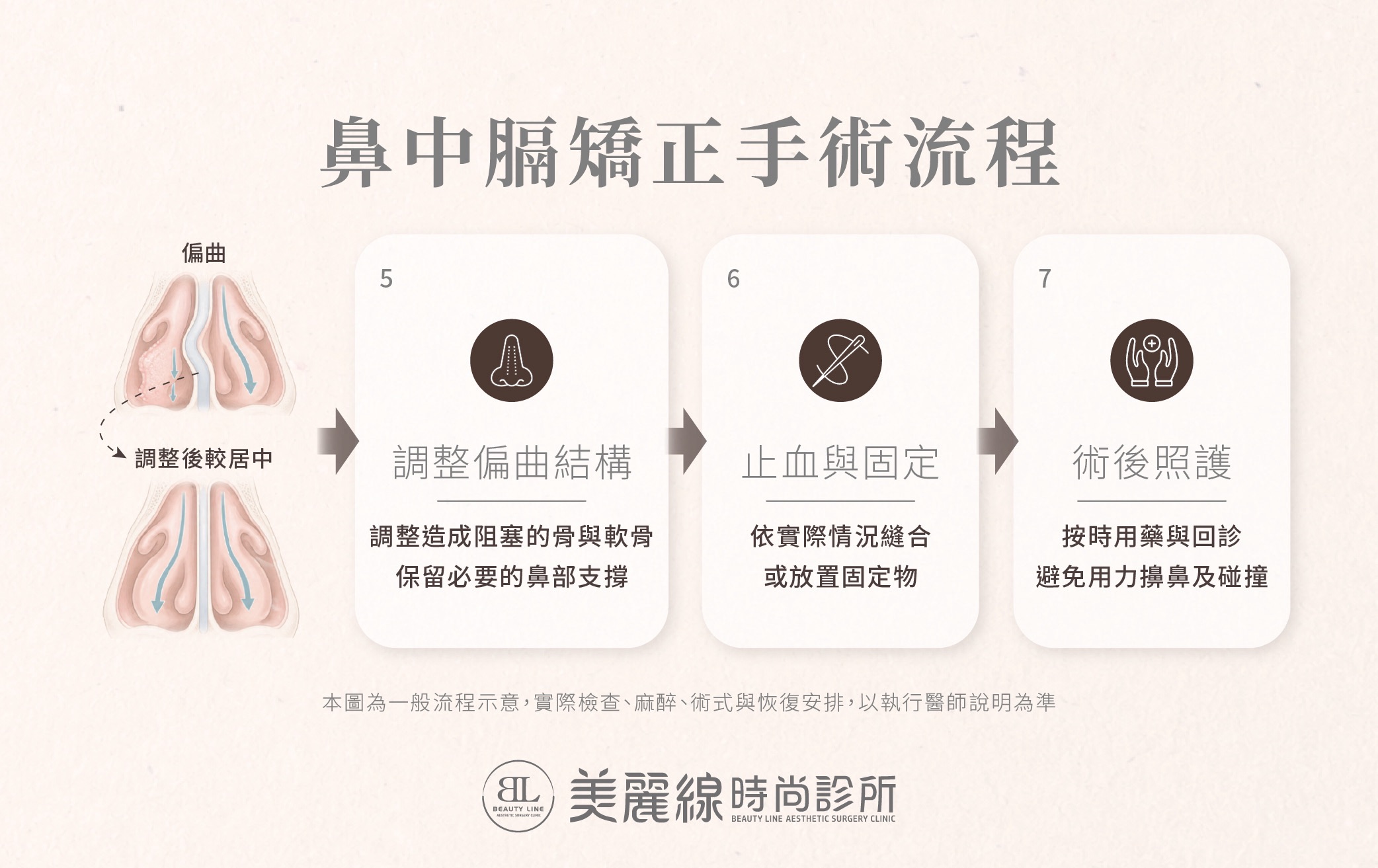 鼻中膈矯正手術流程示意，包含調整偏曲結構、止血與固定及術後照護。