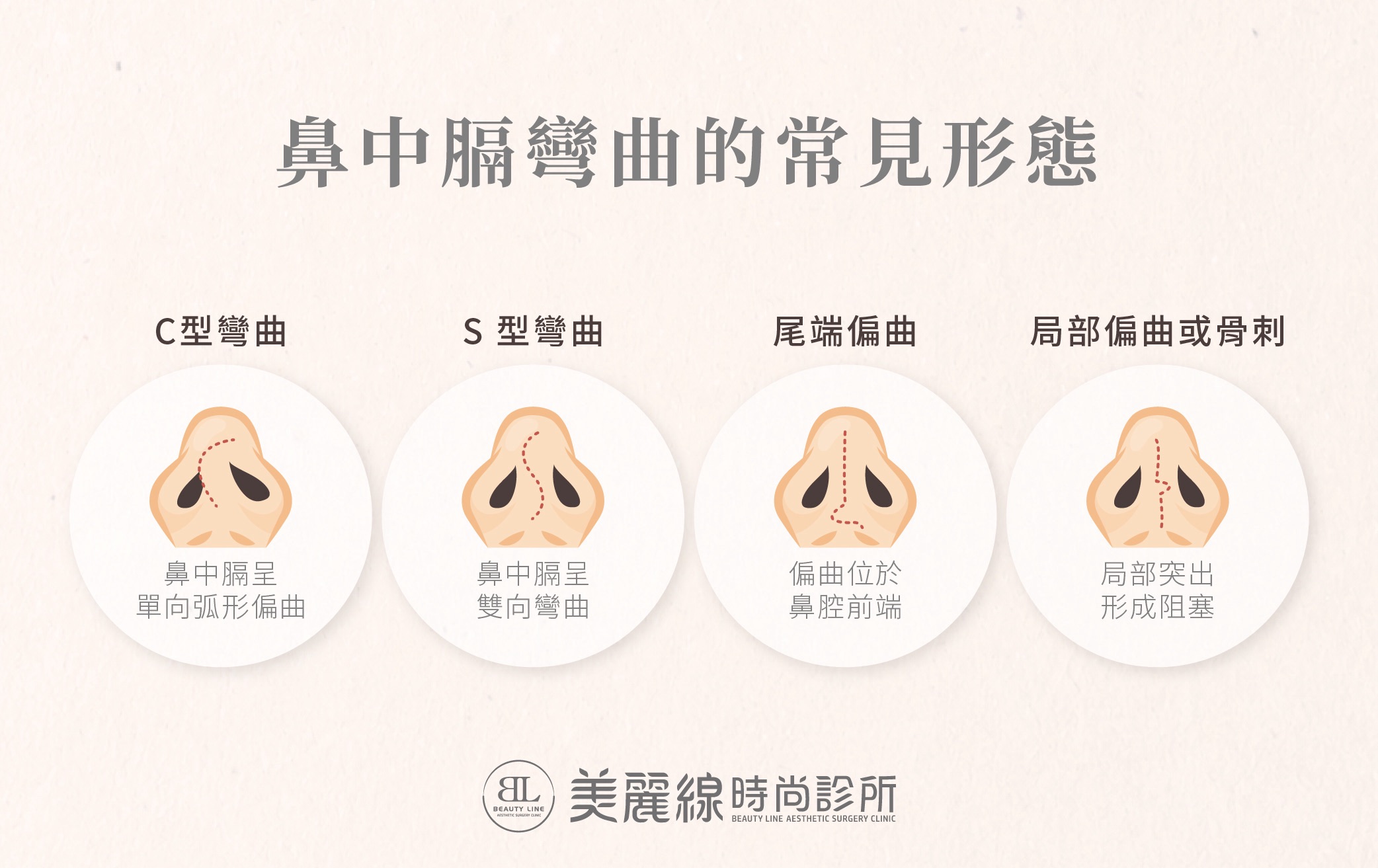 鼻中膈彎曲可能呈現不同形態與偏曲位置。是否需要手術，應綜合評估鼻塞症狀、生活影響與鼻部結構，不能只依彎曲外觀判斷。